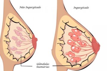 Ilustração de ingurgitamento mamário