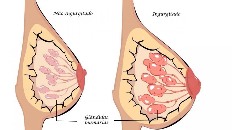 Ilustração de ingurgitamento mamário